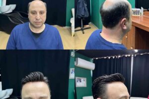 protez saç öncesi ve sonrası sonucu doğal saç görünümü mersin