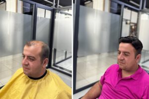 erkek-protez-sac-uygulamasi