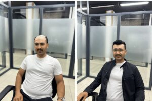 mersin en iyi protez saç