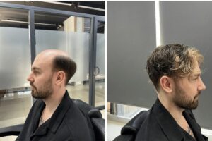 mersin protez saç hizmeti