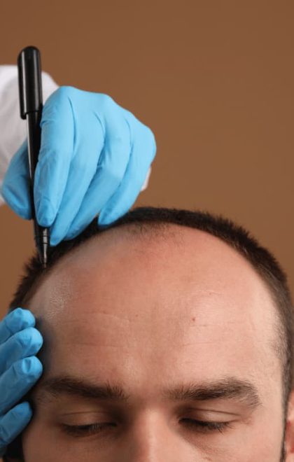 mersin protez saç uygulaması